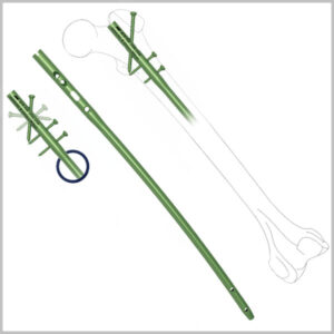 Expert Femur Interlocking Nail